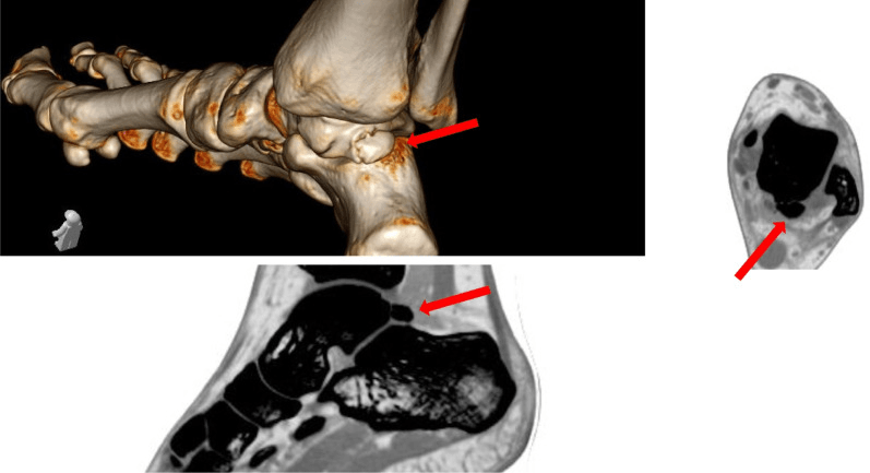 CT and three-dimensional reconstruction of a Shepherd fracture