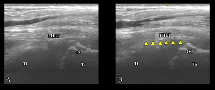Paired ultrasound images of the flexor hallucis longus tendon beside the os trigonum