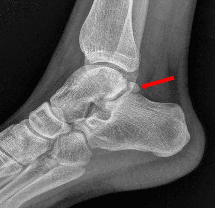 Lateral radiograph showing a Shepherd fracture of the posterior talus