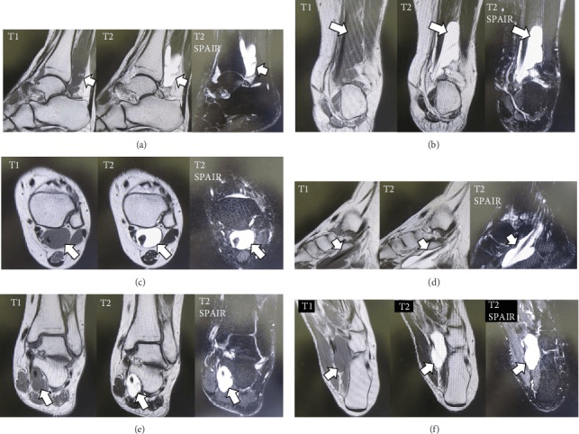 Multiplanar MRI showing flexor hallucis longus tenosynovitis
