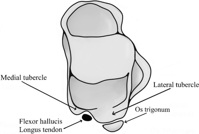 Posterior talar anatomy showing the os trigonum and flexor hallucis longus groove