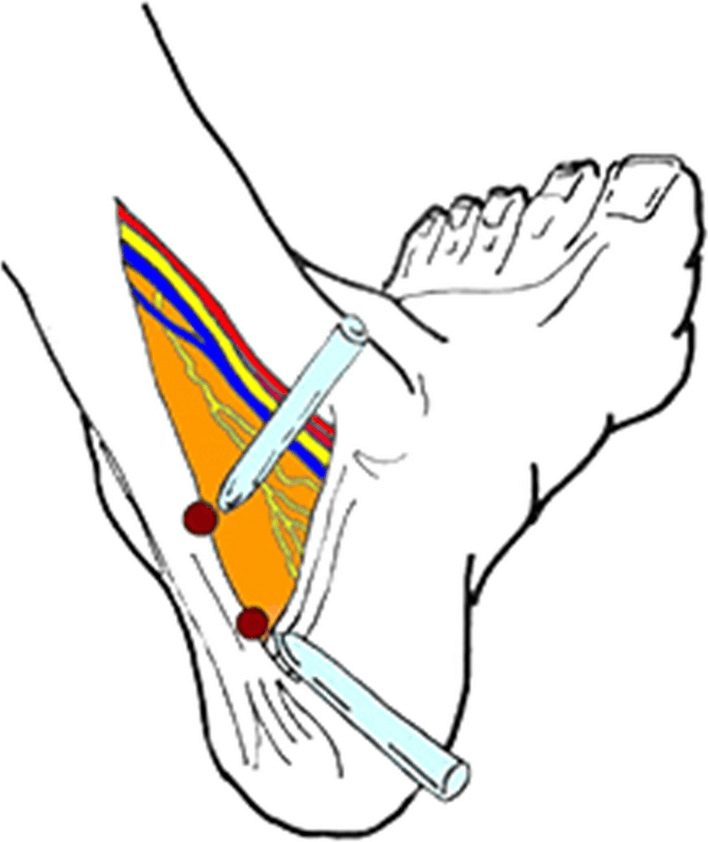 Posterolateral and posteromedial portal positions for hindfoot endoscopy