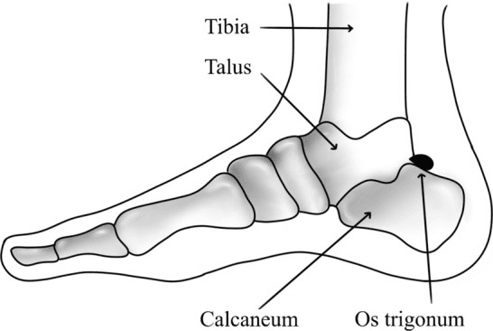 Side-on schematic of the foot and ankle showing the os trigonum between the tibia, talus and calcaneum