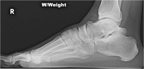 Weight-bearing lateral radiograph showing an elongated Stieda process