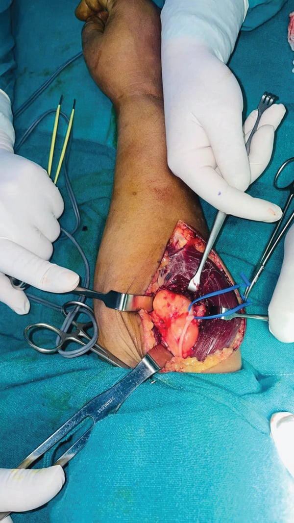 Operative photograph showing division of the arcade of Frohse over the posterior interosseous nerve.