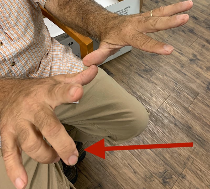 Right hand demonstrating isolated drop of the middle and ring fingers from posterior interosseous nerve palsy.