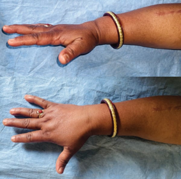 Clinical photograph demonstrating restored thumb and finger extension six months after posterior interosseous nerve decompression.