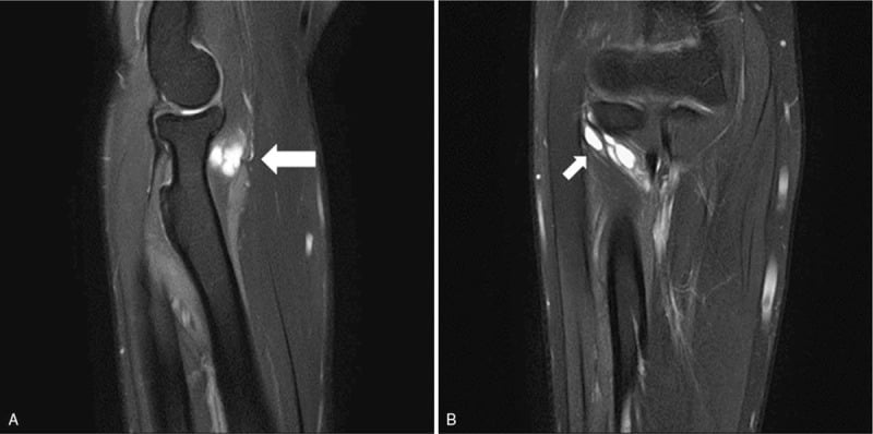 Sagittal and coronal MRI showing a multilobulated ganglion anterior to the radial head.