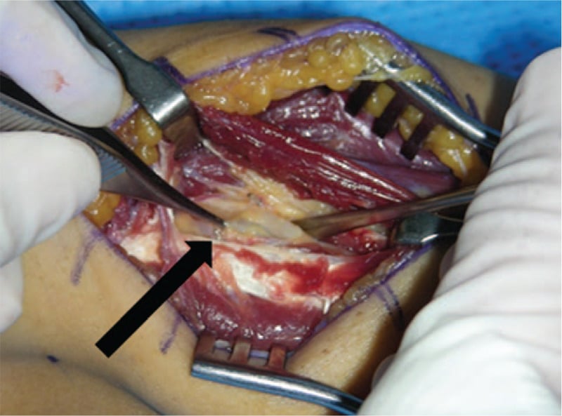 Operative photograph showing the posterior interosseous nerve compressed by a ganglion at the anterolateral elbow.