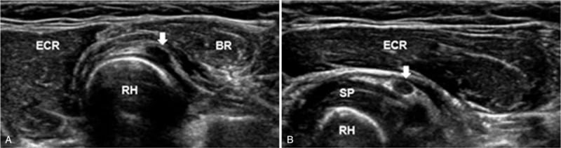Axial and longitudinal ultrasound showing a well-defined ganglion cyst beside the radial head.