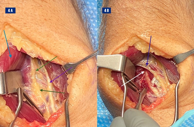 Two-panel operative photograph showing the posterior interosseous nerve tethered by adhesions and then exposed after arcade release.