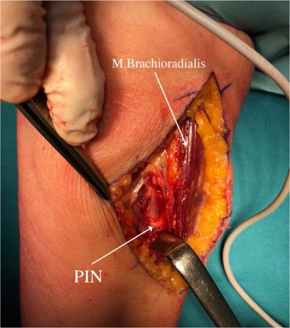 Operative field after lipoma excision showing the decompressed posterior interosseous nerve.
