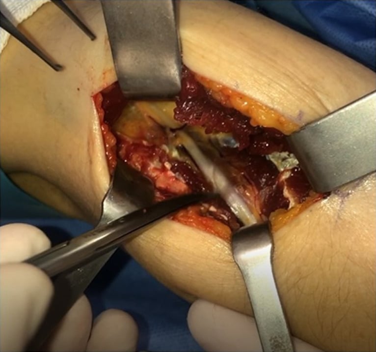 Operative photograph showing the posterior interosseous nerve after release of the supinator.