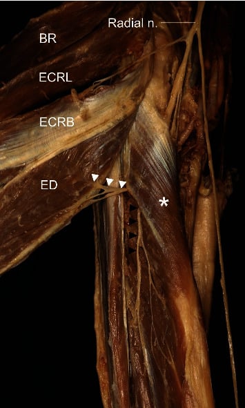 Cadaveric proximal forearm dissection showing superficial and deep branches of the posterior interosseous nerve around supinator and extensor digitorum.