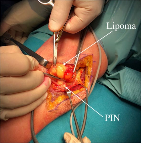 Operative lateral elbow dissection showing a lipoma adjacent to the labelled posterior interosseous nerve.