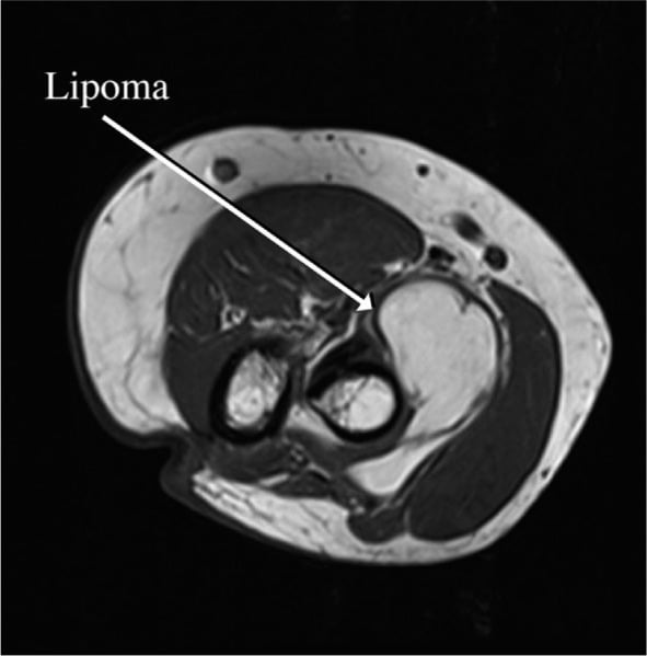 Axial elbow MRI showing a fat-signal lipoma beside the proximal radius and radial nerve.