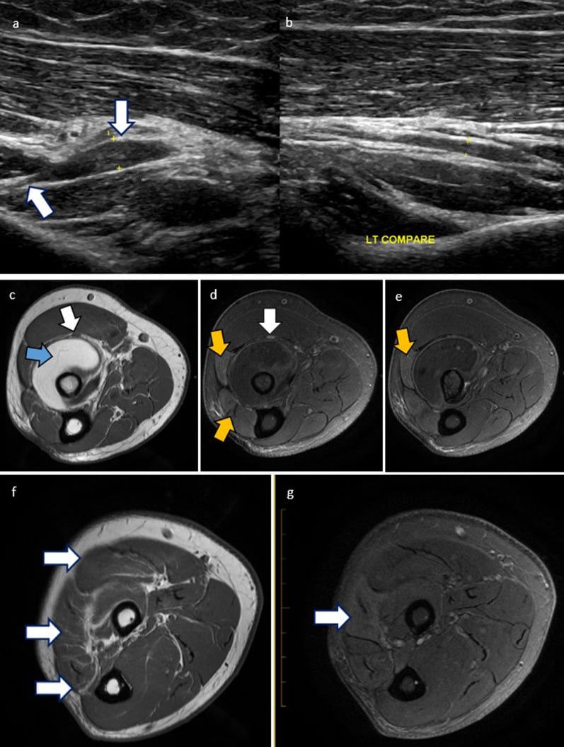 Ultrasound and axial MRI examples of posterior interosseous nerve thickening, supinator lipoma compression and extensor denervation.