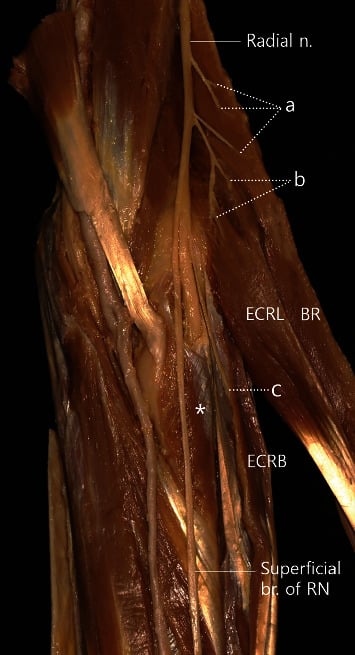 Cadaveric proximal forearm dissection showing the radial nerve and muscular branches to brachioradialis, ECRL and ECRB before its superficial and deep divisions.