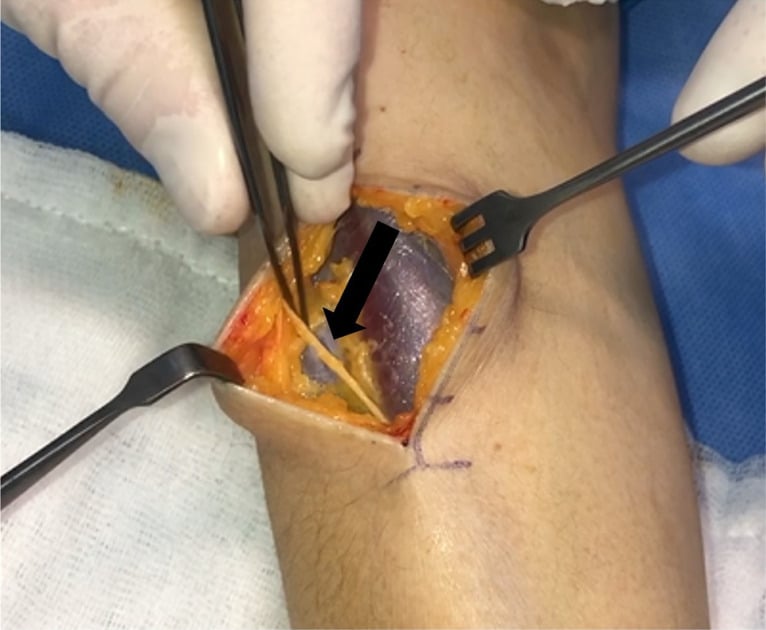 Operative exposure of the radial tunnel showing a cutaneous nerve protected under a skin retractor.