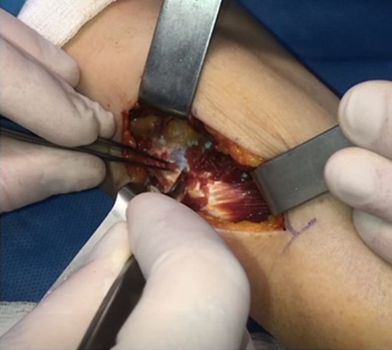 Operative photograph showing the supinator fascia and muscle being released proximally.