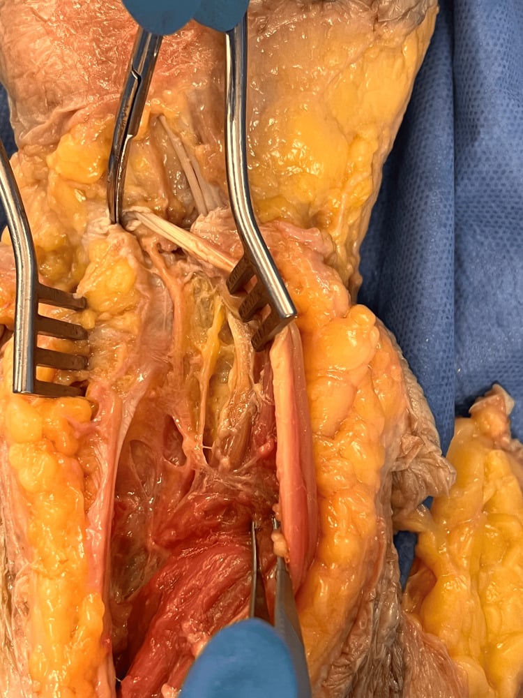 Dorsal wrist cadaveric dissection showing terminal posterior interosseous nerve branches to the DRUJ, TFCC and radiocarpal joint.
