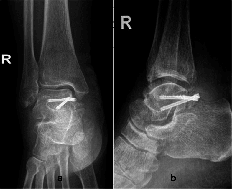 Postoperative AP and lateral radiographs of the right ankle with two screws after Cedell nonunion fixation