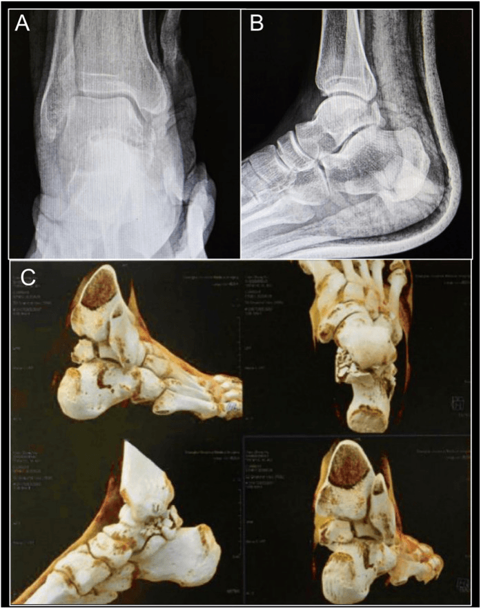 AP and lateral radiographs and three-dimensional CT reconstructions from a case of combined medial and lateral posterior tubercle fractures