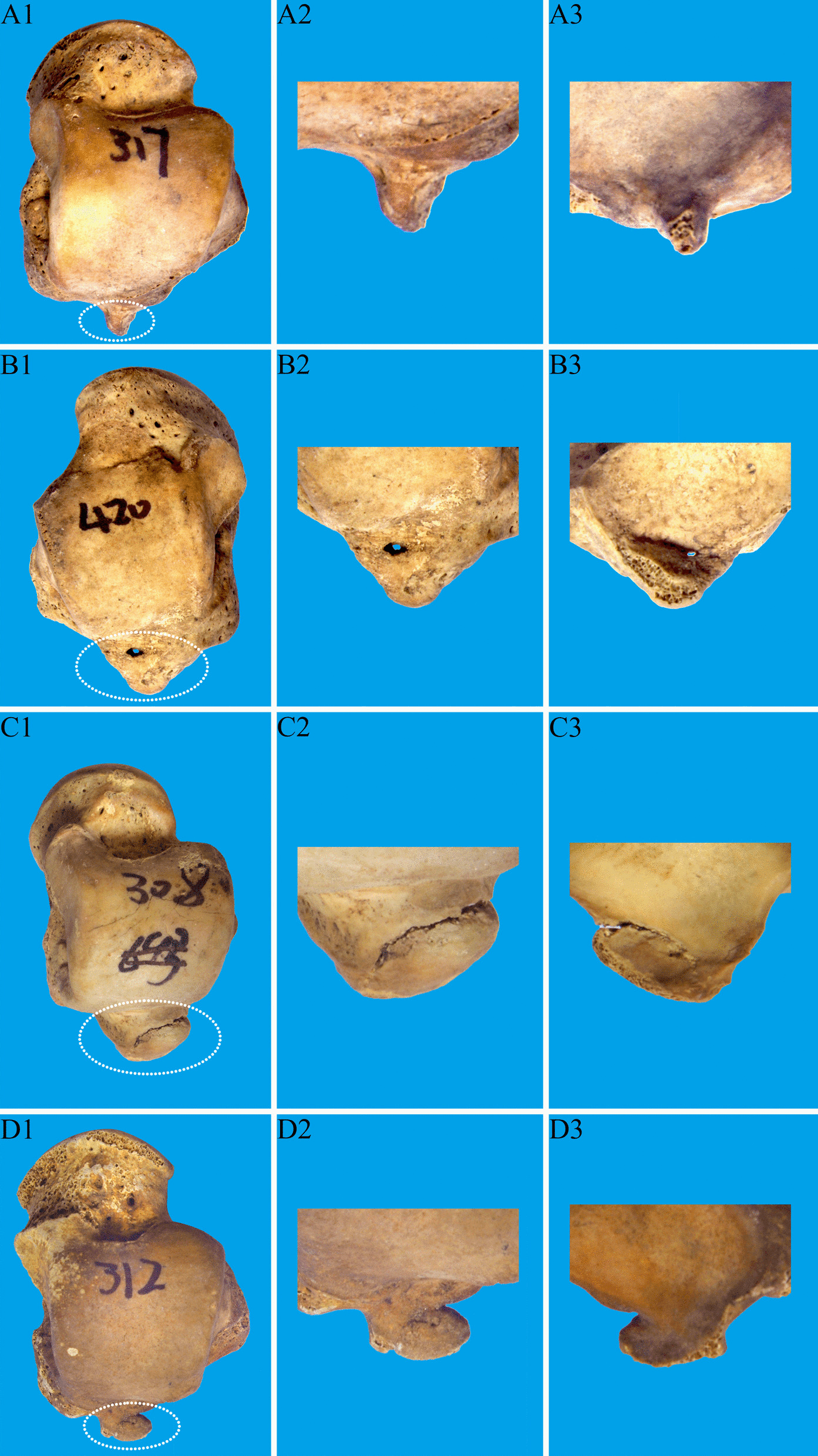 Dry-bone posterior talus fracture patterns across four morphologies, rows A to D