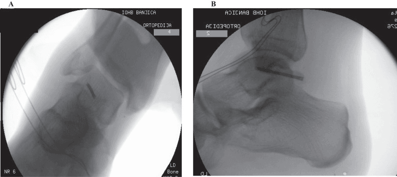 Two intraoperative fluoroscopic views, B a lateral, showing a screw in the posterior talus