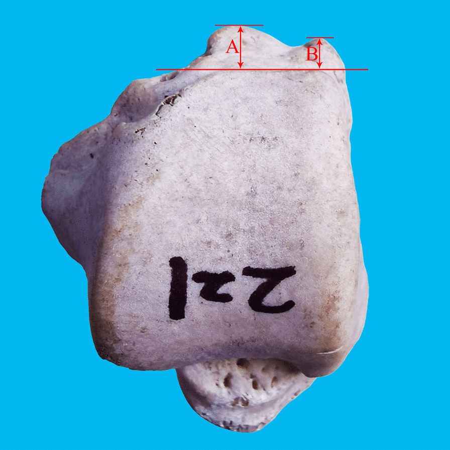 Dry talus with the lengths of the two posterior tubercles, A and B, measured from a reference line