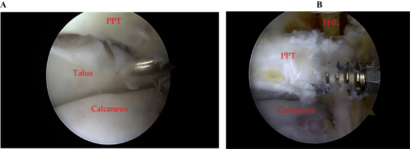 Arthroscopic views labelled PPT, talus, calcaneus and FHL, before and after screw fixation of a posterior talus fragment
