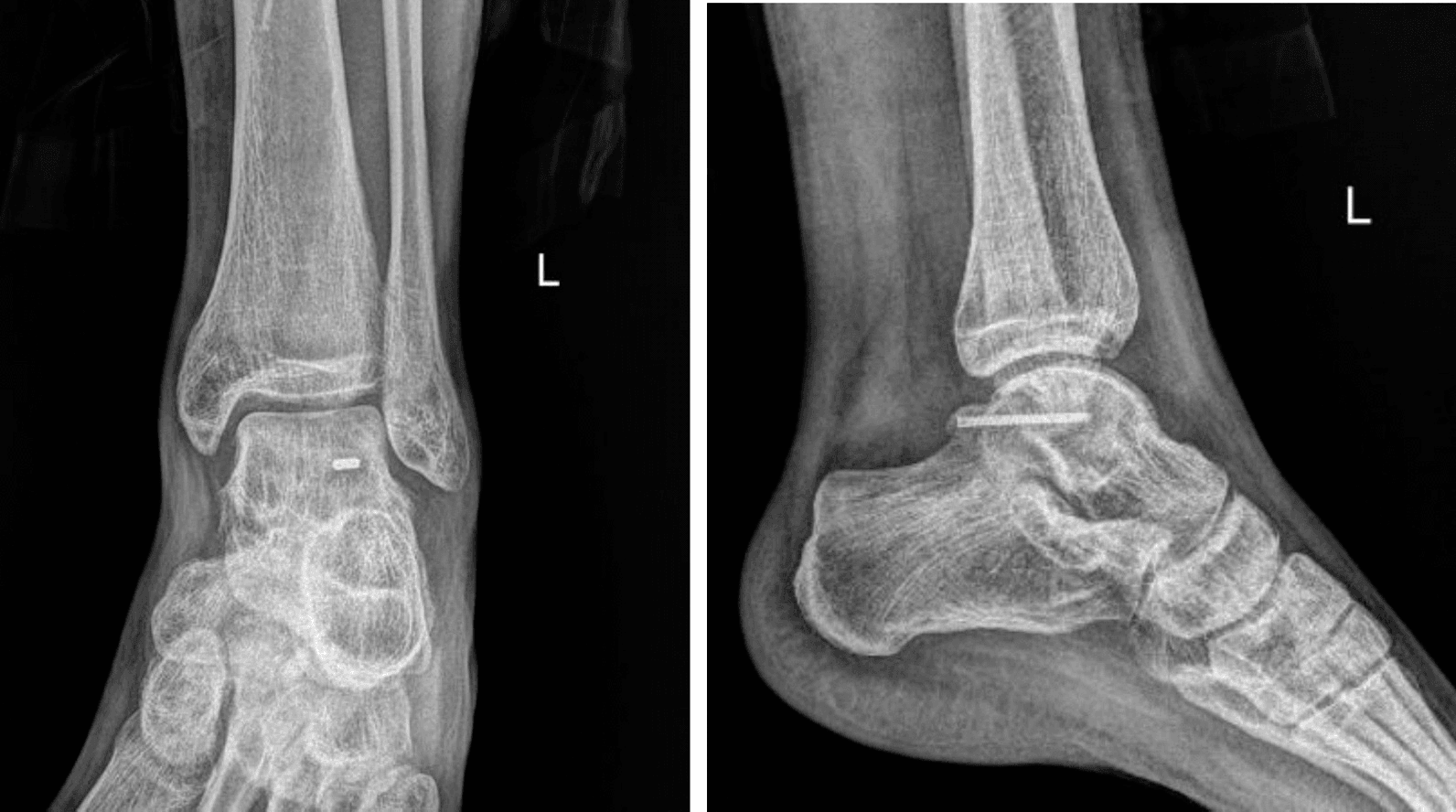 Six-week postoperative AP and lateral radiographs of the left ankle after Shepherd fracture fixation