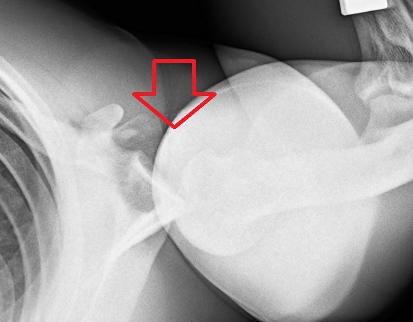 Axillary view of the shoulder showing a posterior dislocation