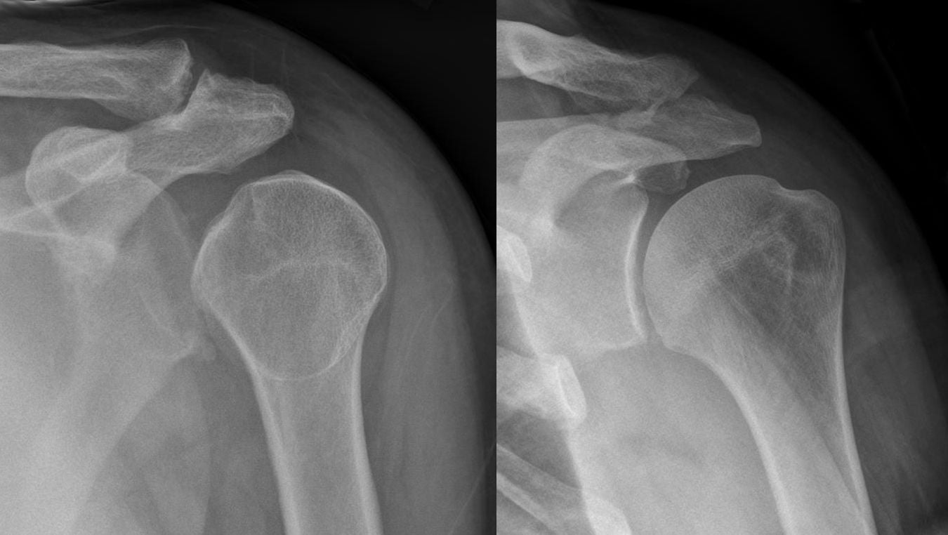 AP shoulder radiographs before and after reduction of a posterior dislocation showing the light bulb sign
