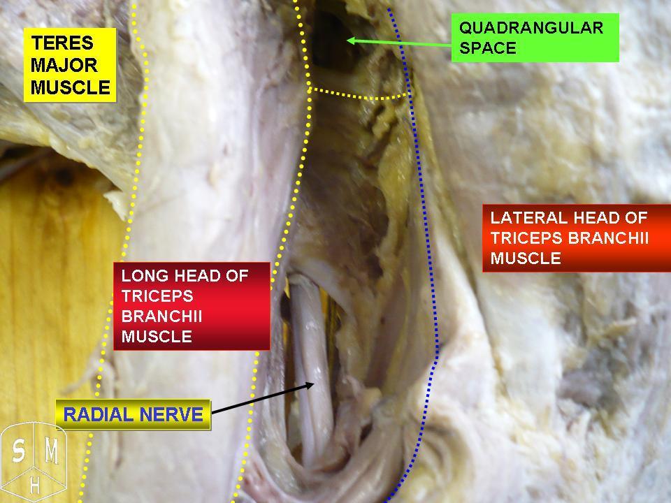 Posterior dissection of the shoulder and proximal arm with teres major, the long and lateral heads of triceps, the quadrangular space and radial nerve labelled.