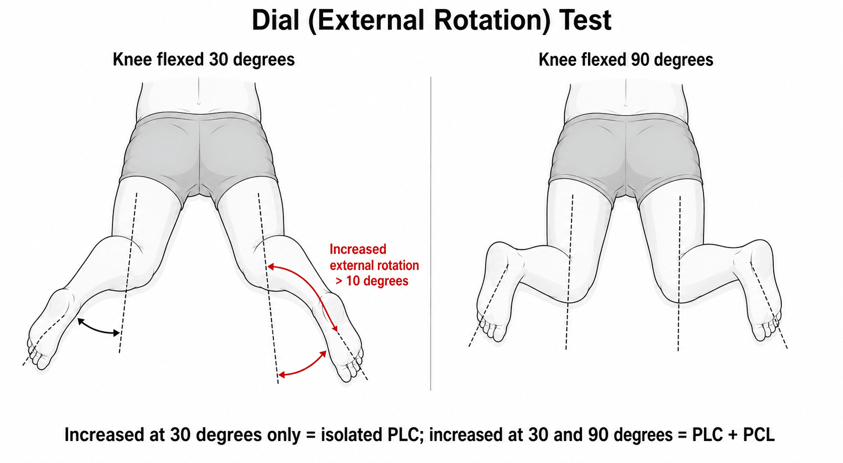 Diagram of the dial (external rotation) test performed prone at 30 and 90 degrees of knee flexion, comparing thigh-foot angle to detect posterolateral corner versus combined PCL injury.
