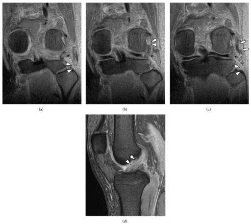 Coronal and sagittal T2-weighted knee MRI of a posterolateral corner injury, arrowheads marking the disrupted biceps femoris and popliteus