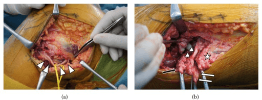 Posterolateral Corner Injuries - intraoperative photographs showing posterolateral knee dissection and tendon repair with suture placement.