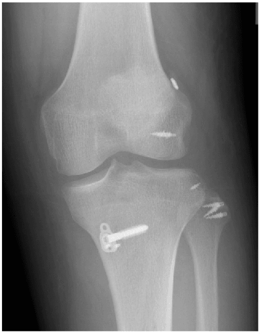 Anteroposterior knee radiograph after posterolateral corner repair showing fixation hardware