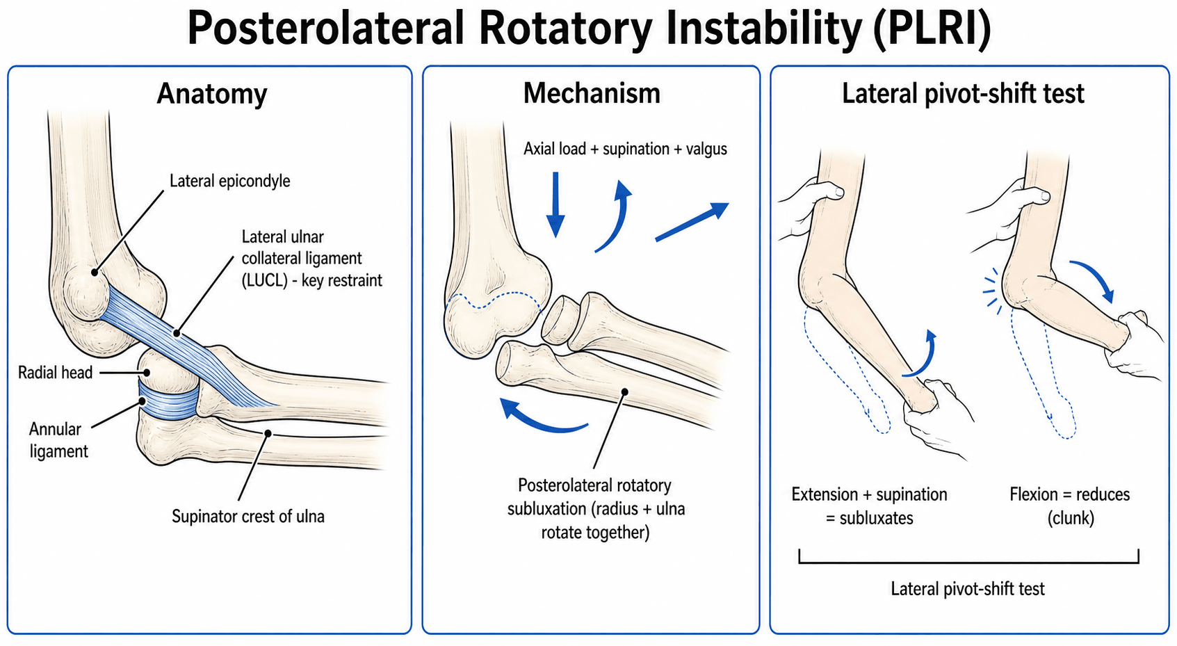 Three-panel diagram of posterolateral rotatory instability of the elbow: the lateral ulnar collateral ligament anatomy, the supination-valgus-axial-load mechanism, and the lateral pivot-shift test.