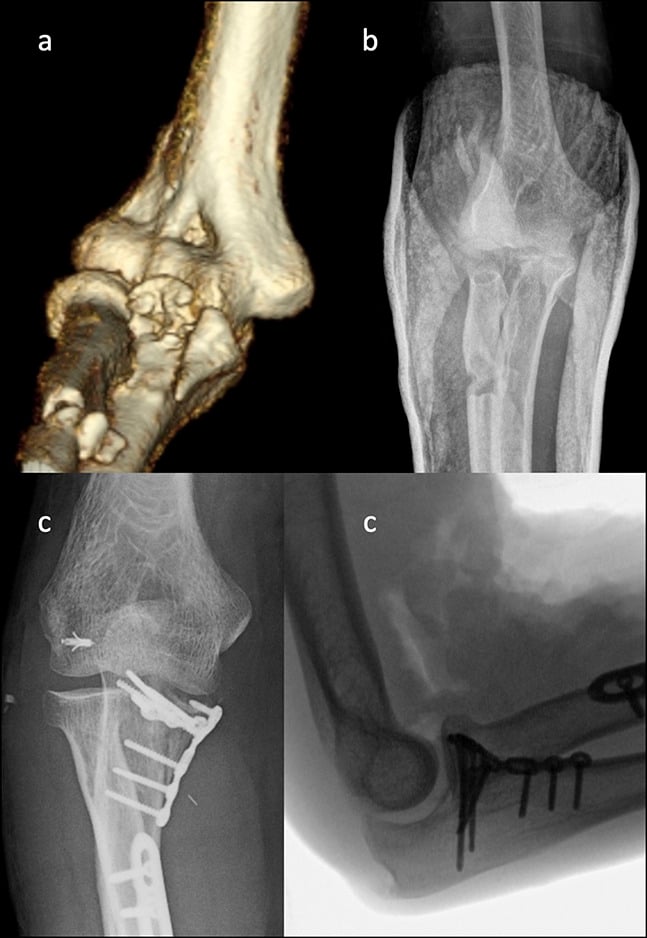 Three-dimensional CT and radiograph of an anteromedial coronoid fracture with postoperative films after coronoid plating and ligament repair