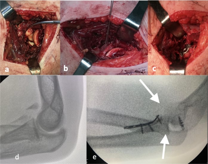 Intraoperative photographs of the anteromedial approach exposing the coronoid fracture with provisional Kirschner wire reduction and plate fixation, with fluoroscopic confirmation