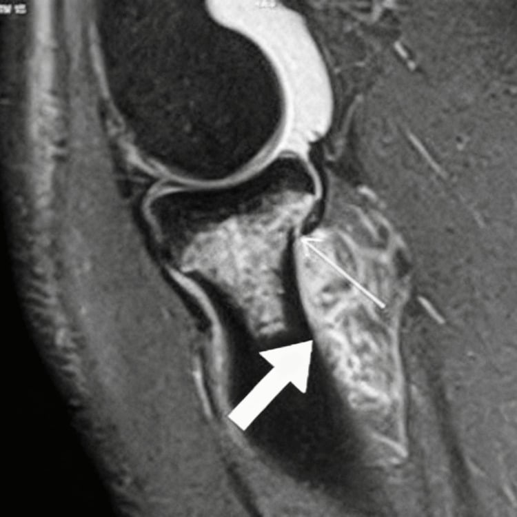 MRI of the elbow with a thick arrow marking a high-grade supinator muscle tear and a thin arrow marking an undisplaced radial neck fracture