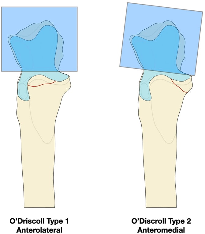 Diagrams of the O Driscoll type 1 anterolateral and type 2 anteromedial coronoid fracture planes