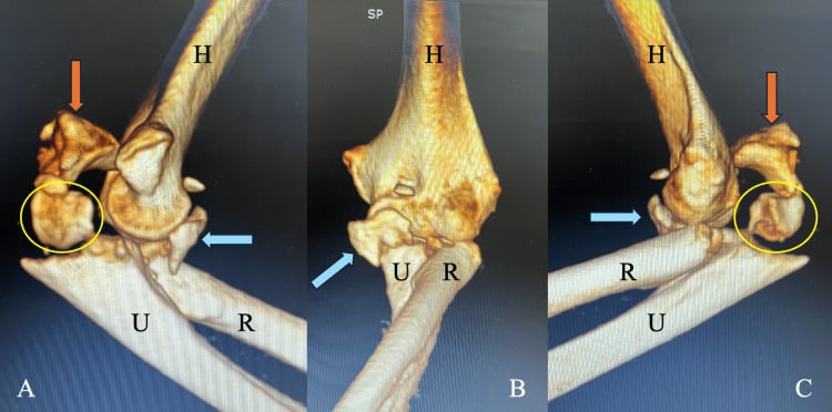 Three-dimensional CT reconstructions in medial, anterior and lateral views showing a terrible triad injury associated with an olecranon fracture
