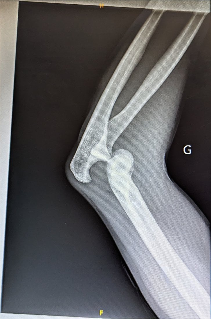 Lateral elbow radiograph showing a posterior elbow dislocation without fracture, the forearm displaced posteriorly relative to the humerus.
