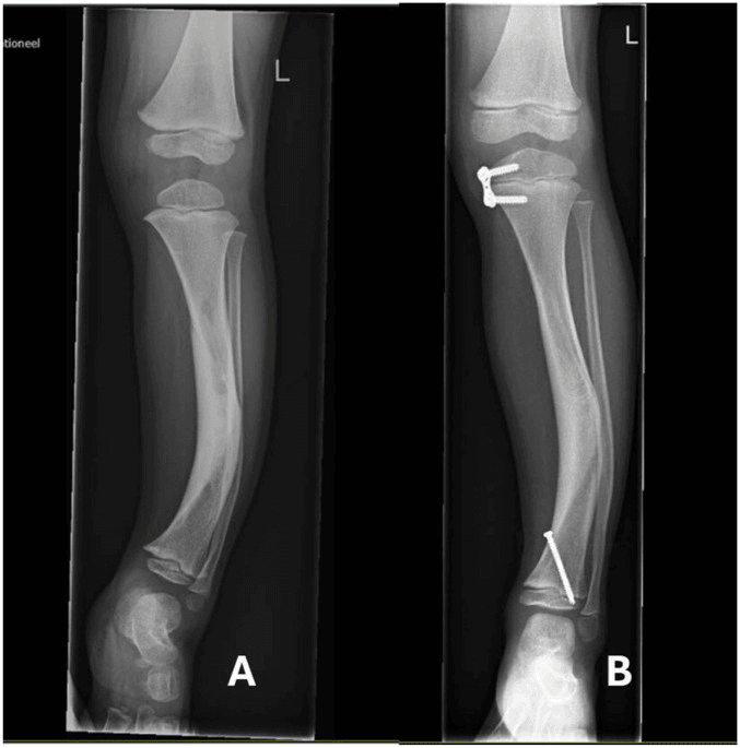 Frontal radiographs of a left leg with anterolateral tibial bowing in a child with neurofibromatosis type 1 (A), and a follow-up film with guided-growth implants at the proximal and distal tibia (B)