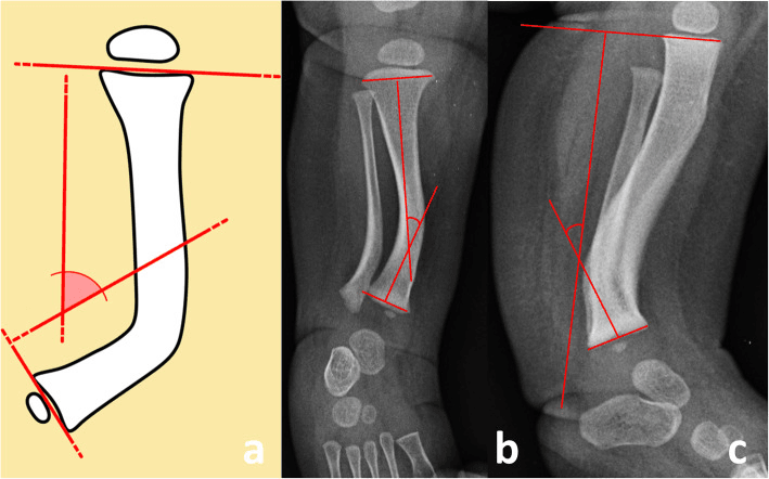 Schematic (a) with AP (b) and lateral (c) tibial radiographs showing the interphyseal angle drawn between lines perpendicular to the proximal and distal physes