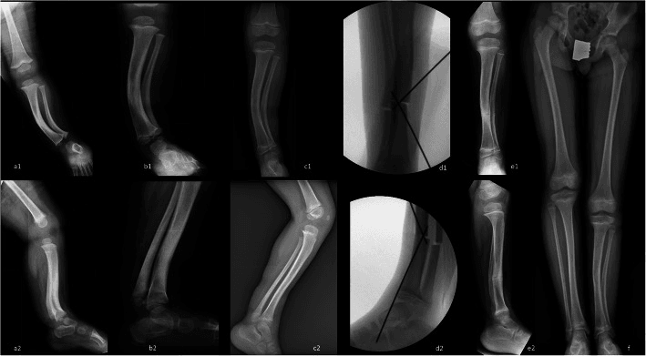Serial paired frontal and lateral tibial radiographs (a to c, e), two fluoroscopic images with drawn lines (d1, d2) and a full-length standing film of both legs (f), following residual posteromedial bow through corrective osteotomy