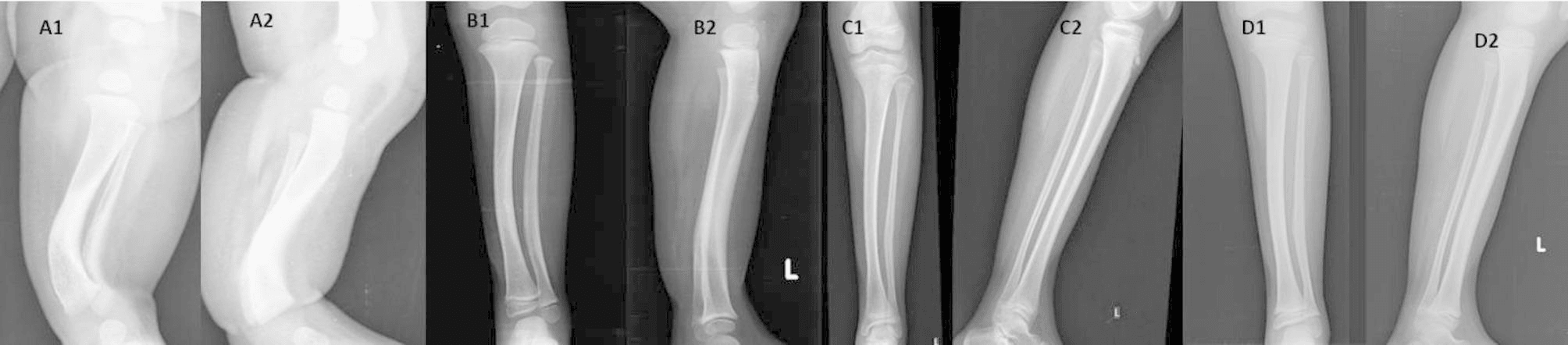 Paired frontal and lateral tibial radiographs at four stages (A to D) showing angular remodelling through childhood